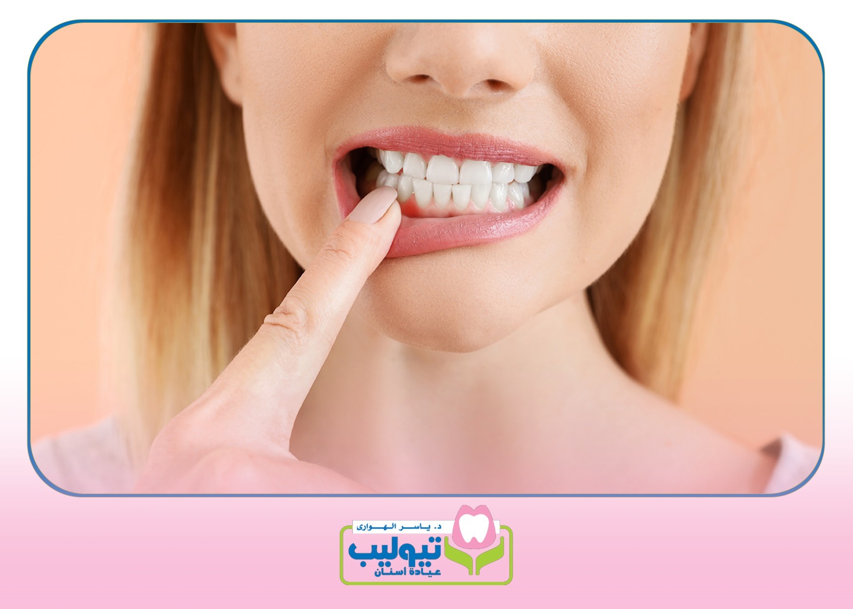 تعديل الأسنان بالتقويم image